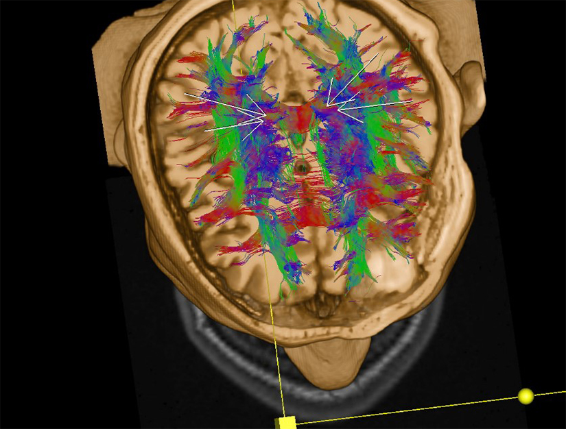 Imagistica tensorului de difuzie si tractografia RMN – metode moderne de neuroimagistica