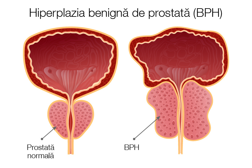 Hiperplazia benigna de prostata (HBP) – semne, simptome, cauze, factori de risc, diagnostic, tratament