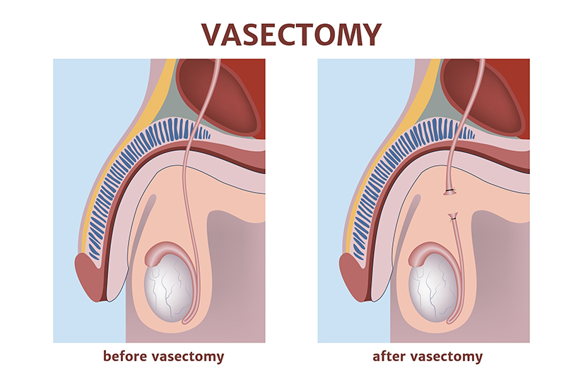 vasectomia1
