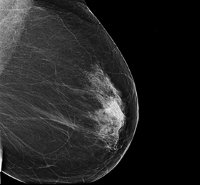 mamografie tomosinteza