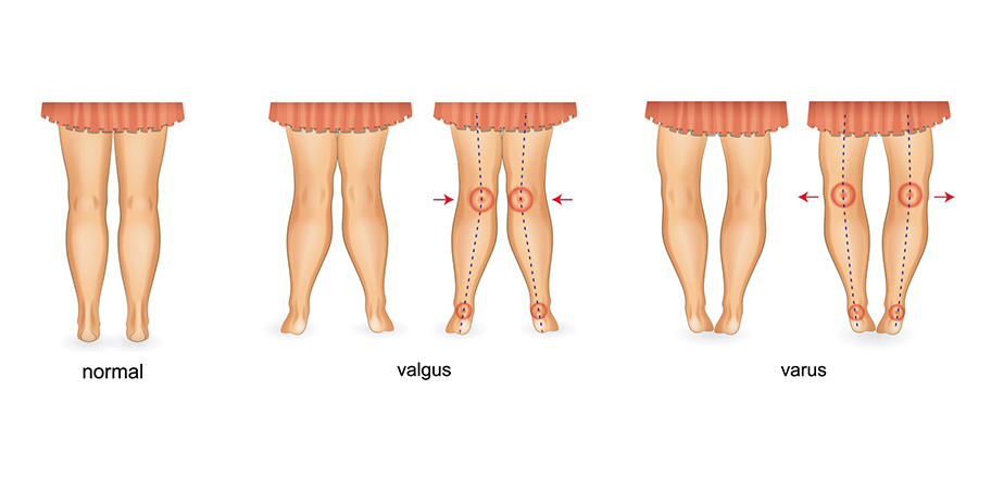 Tratamentul deformării genunchiului