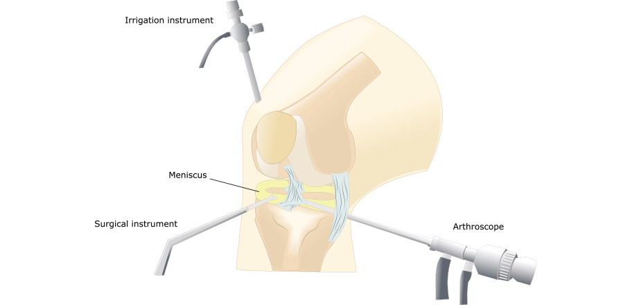 Artroscopie | Procedura ortopedica eficienta si minim invaziva