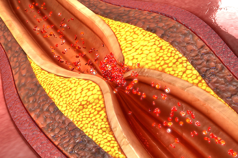 Boala arteriala coronariana