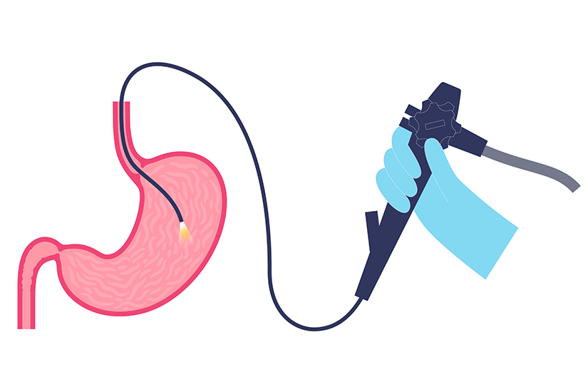 Endoscopia digestiva superioara