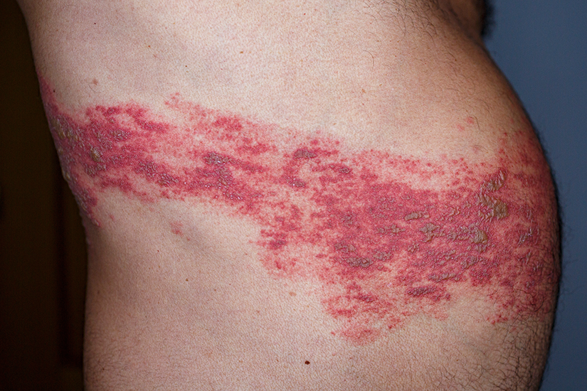 zona zoster faza acuta