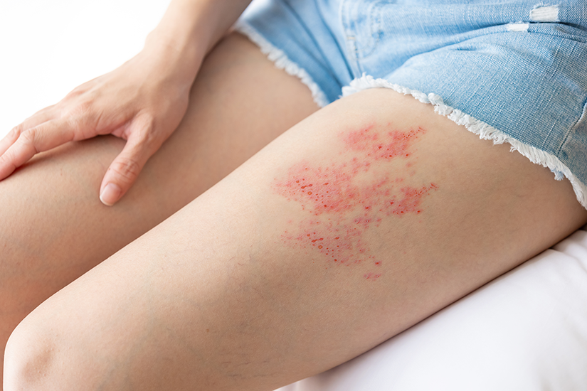 zona zoster member inferioare