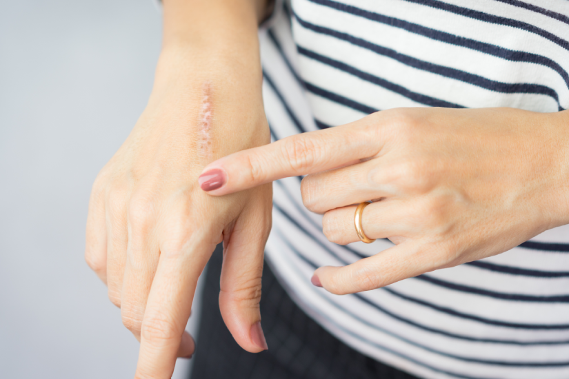 arsura superficiala mana