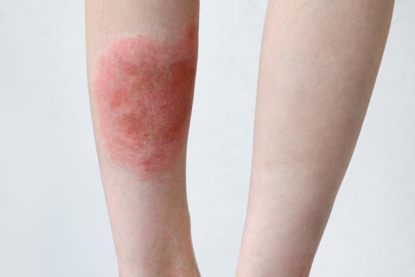 eritem langa muscatura