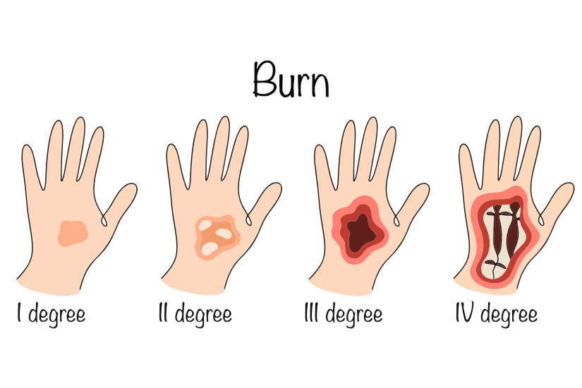 tipuri de arsuri mana