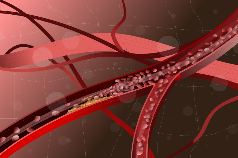 ilustratie artera colesterol