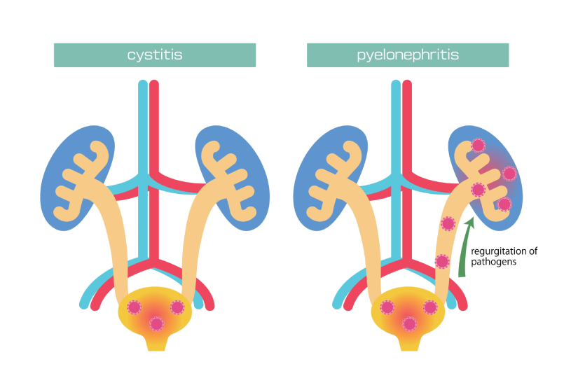 cistita vs pielonefrita