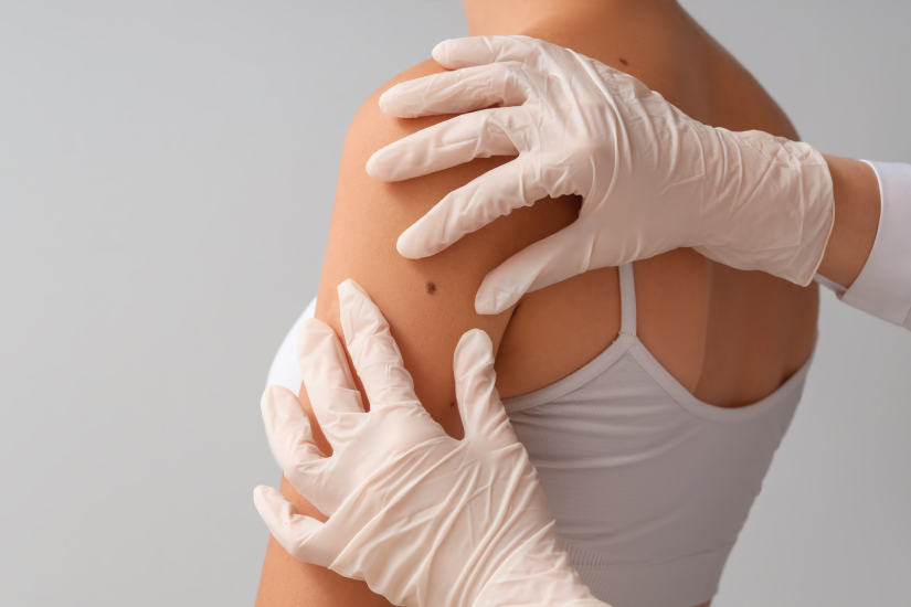 medic dermatolog examinează alunița