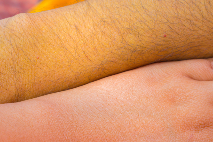 Îngălbenirea pielii