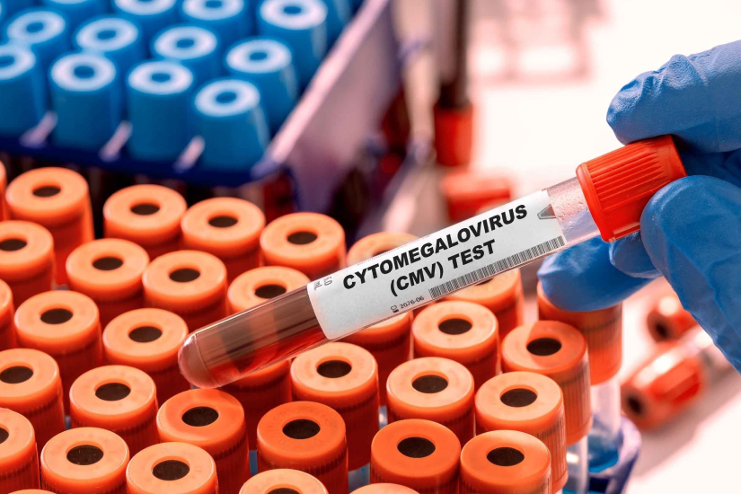 Analiza ADN specific CMV