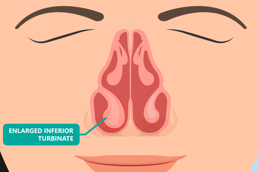 Cornete nazale mărite