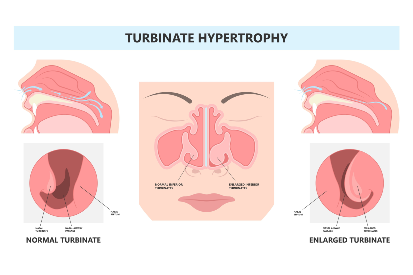 Hipertrofia cornetelor nazale