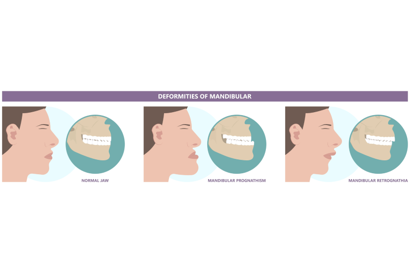 Ilustrație comparativă cu mandibulă normală, prognatism mandibular și retrognatism mandibular, evidențiind poziția retrasă a maxilarului inferior față de baza craniului
