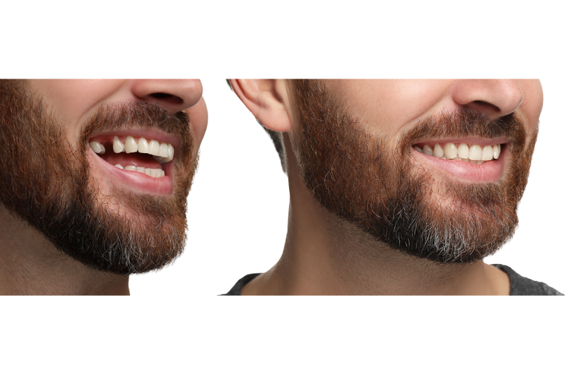 	Implant Bredent cu aspect natural