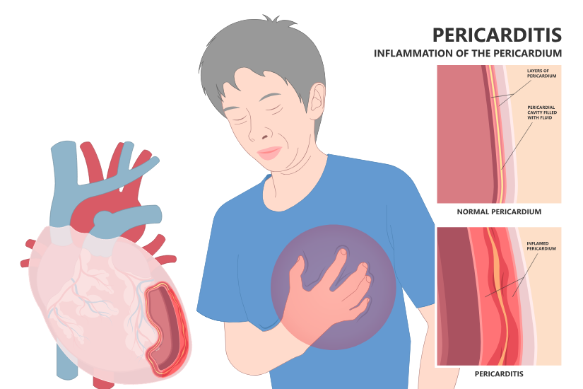 Inflamația pericardului