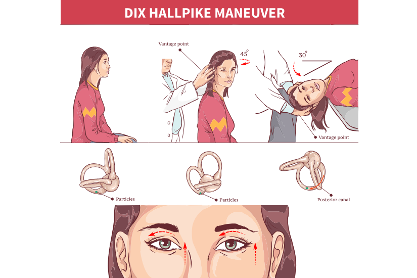 Manevra Dix-Hallpike