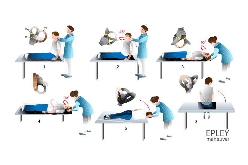 Manevra Epley