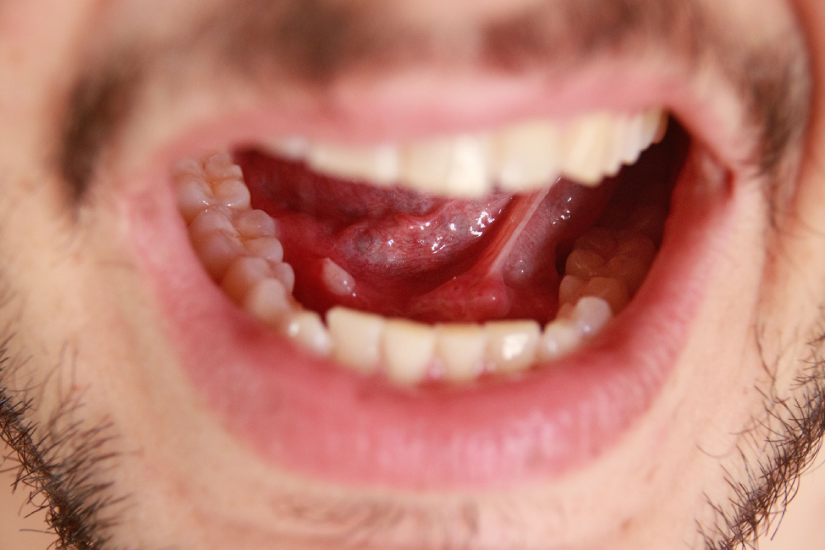 Piatră la glanda salivară