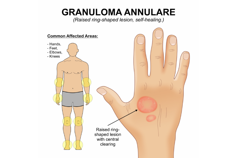 Simptomele granulomului anular