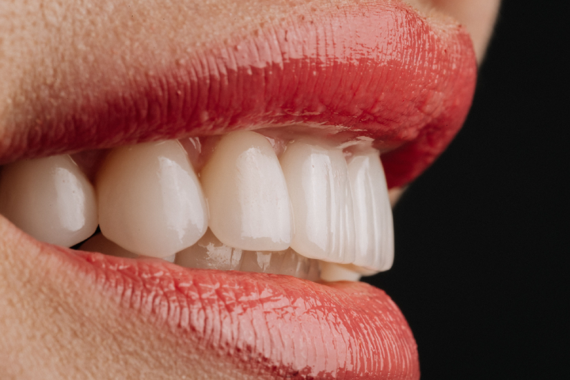 Zâmbet cu aspect natural