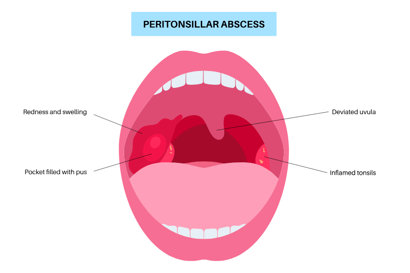 Abces periamigdalian