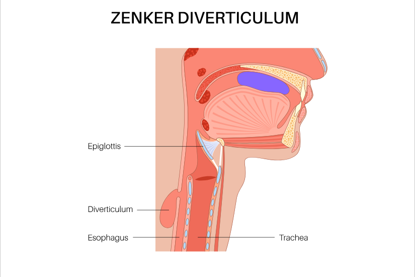 diverticul-zenker
