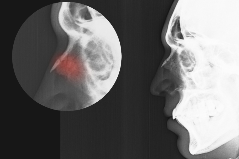 radiografie-fractura-nazala