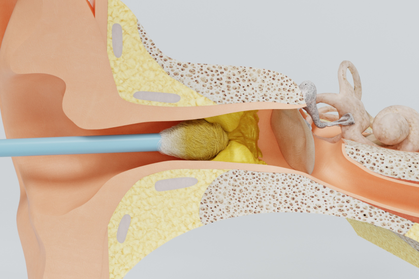 Bețișoarele de urechi împing cerumenul spre membrana timpanică