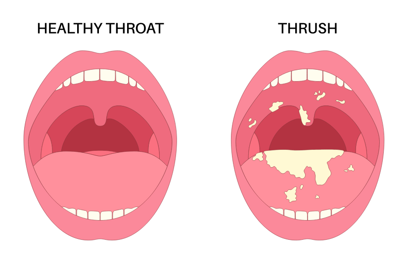 Candidoza orofaringiană – ilustrație