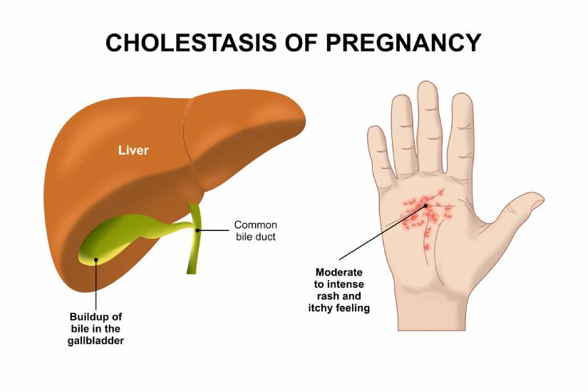Colestaza intrahepatică de sarcină
