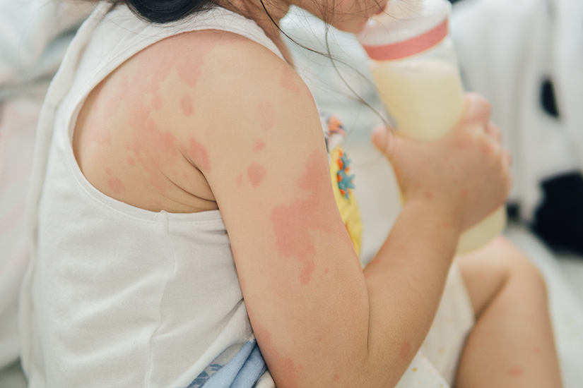 alergie-proteina-lapte