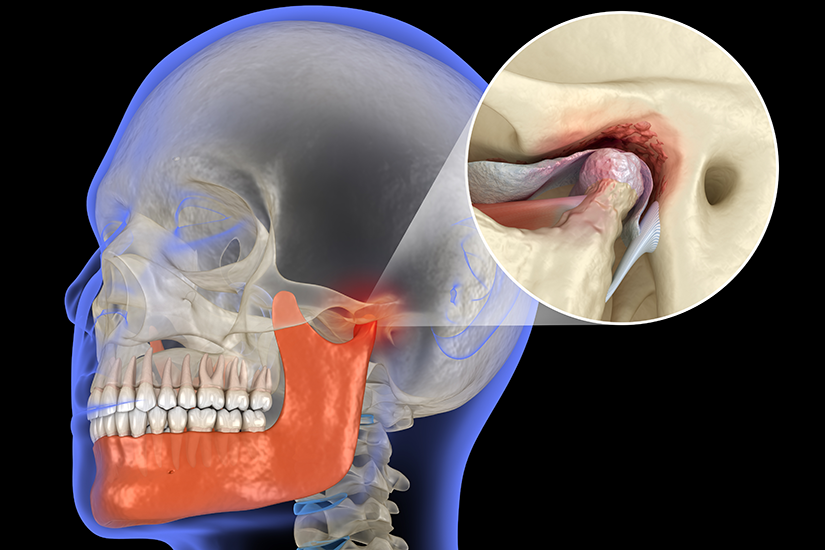 dislocare-disc-articulatie-temporo-mandibulara