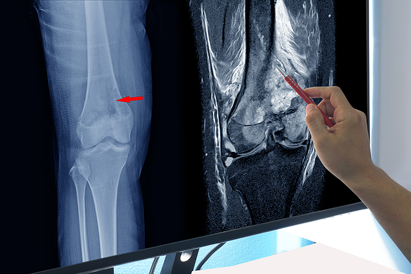 radiografie-osteosarcom