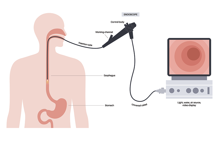 Endoscopia digestivă superioară – ilustrație