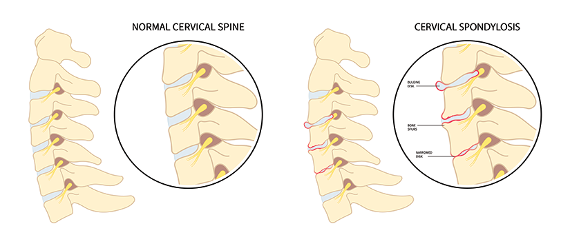 Spondiloza cervicală – ilustrație