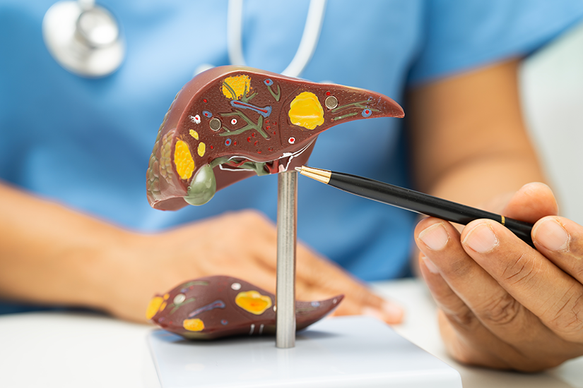 Ciroza hepatică