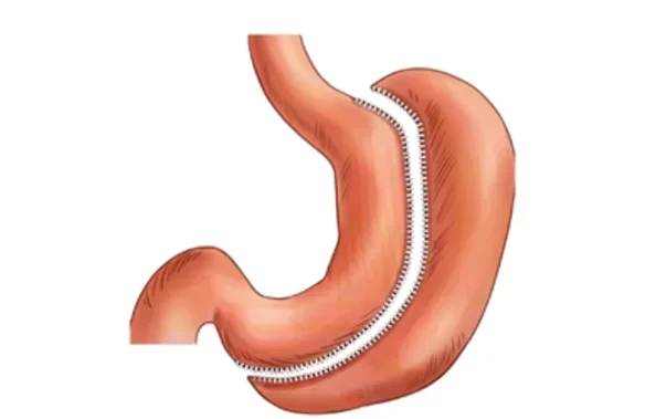 gastric-sleeve