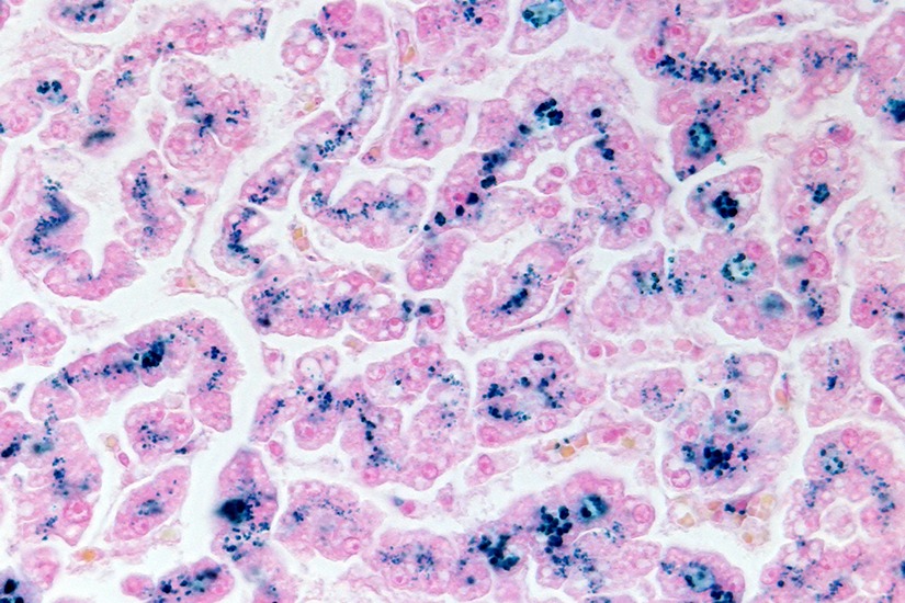 celule-hepatice-cu-exces-de-fier
