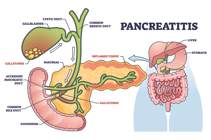 Pancreatită – ilustrație medicală