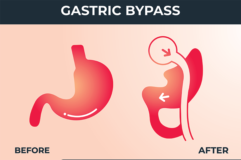 by pass gastric ilustratie