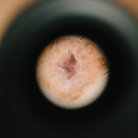 dermatoscopie