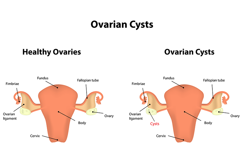 Chist ovarian - ilustrație medicală