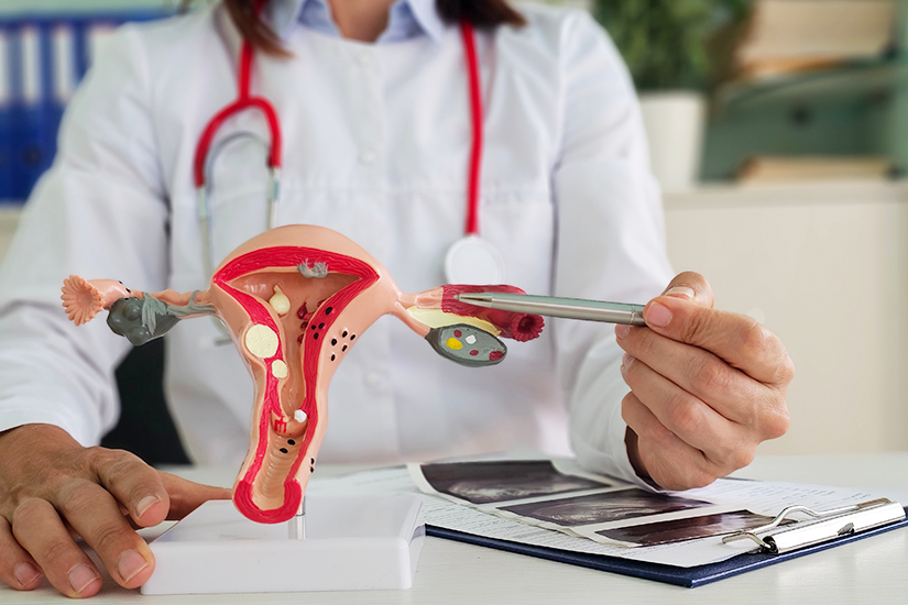 Chist ovarian