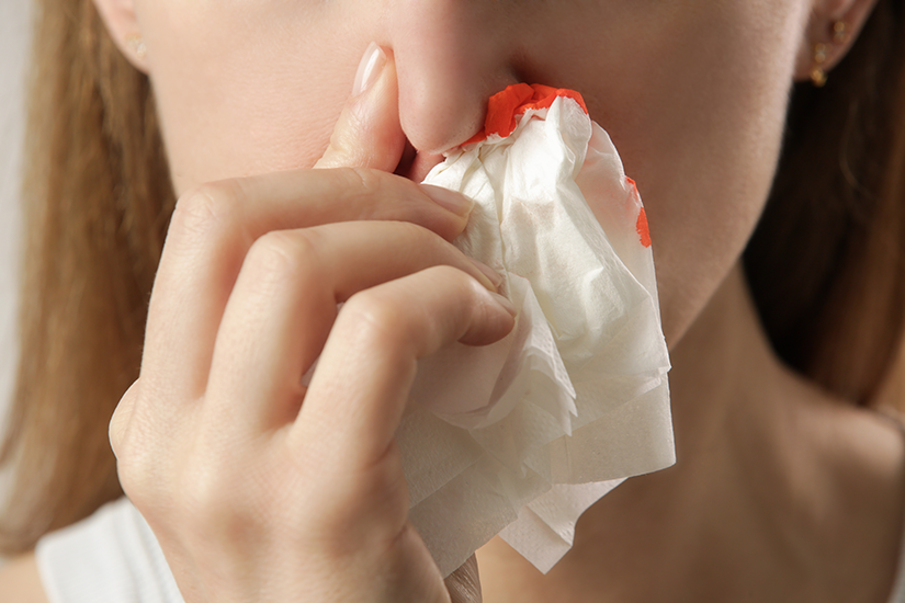 Epistaxis