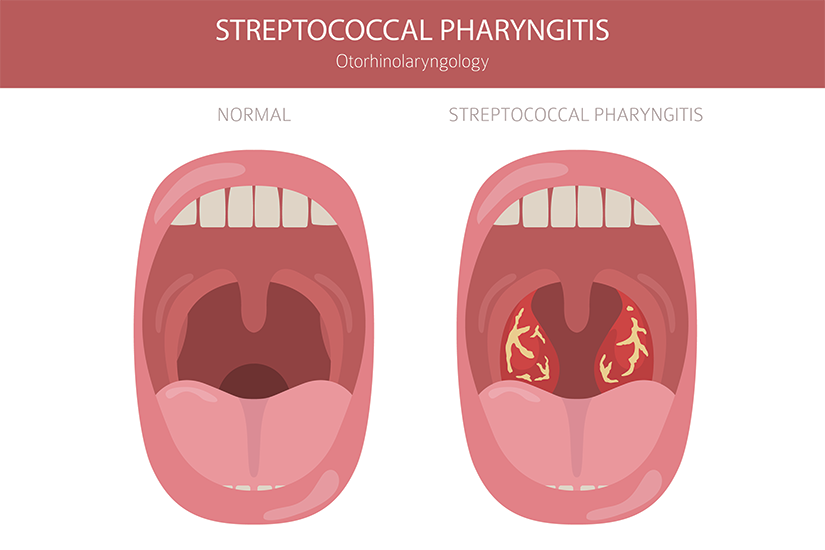Faringită streptococică – ilustrație medicală