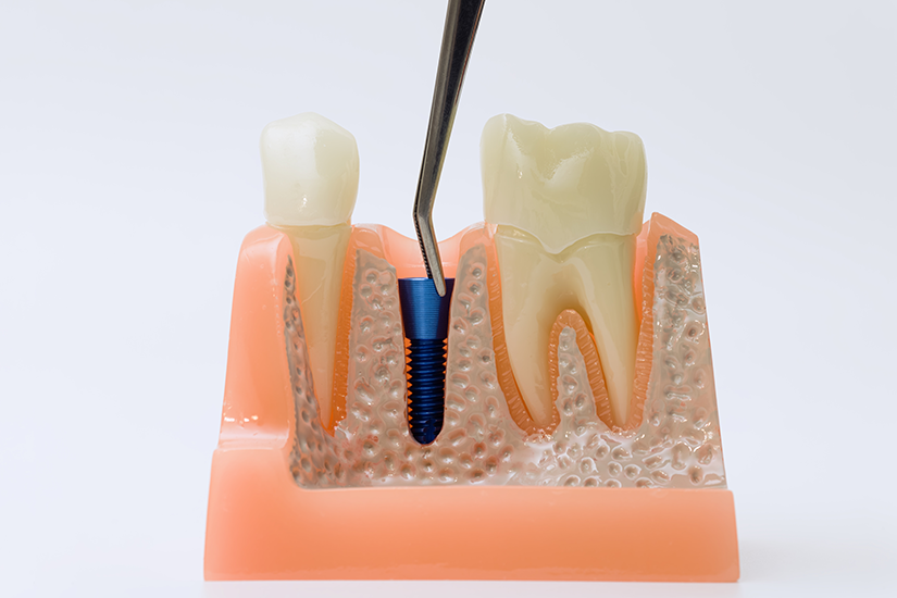 implant-intre-doi-dinti-naturali